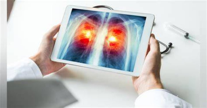 New Study Supports Saving More Lung Tissue in Lung Cancer Surgeries