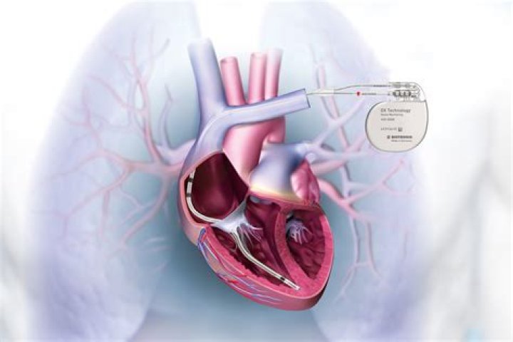Patient Successfully Implanted with Permanent Heart Implant, the Only FDA-Approved Device to Reduce Stroke Risk